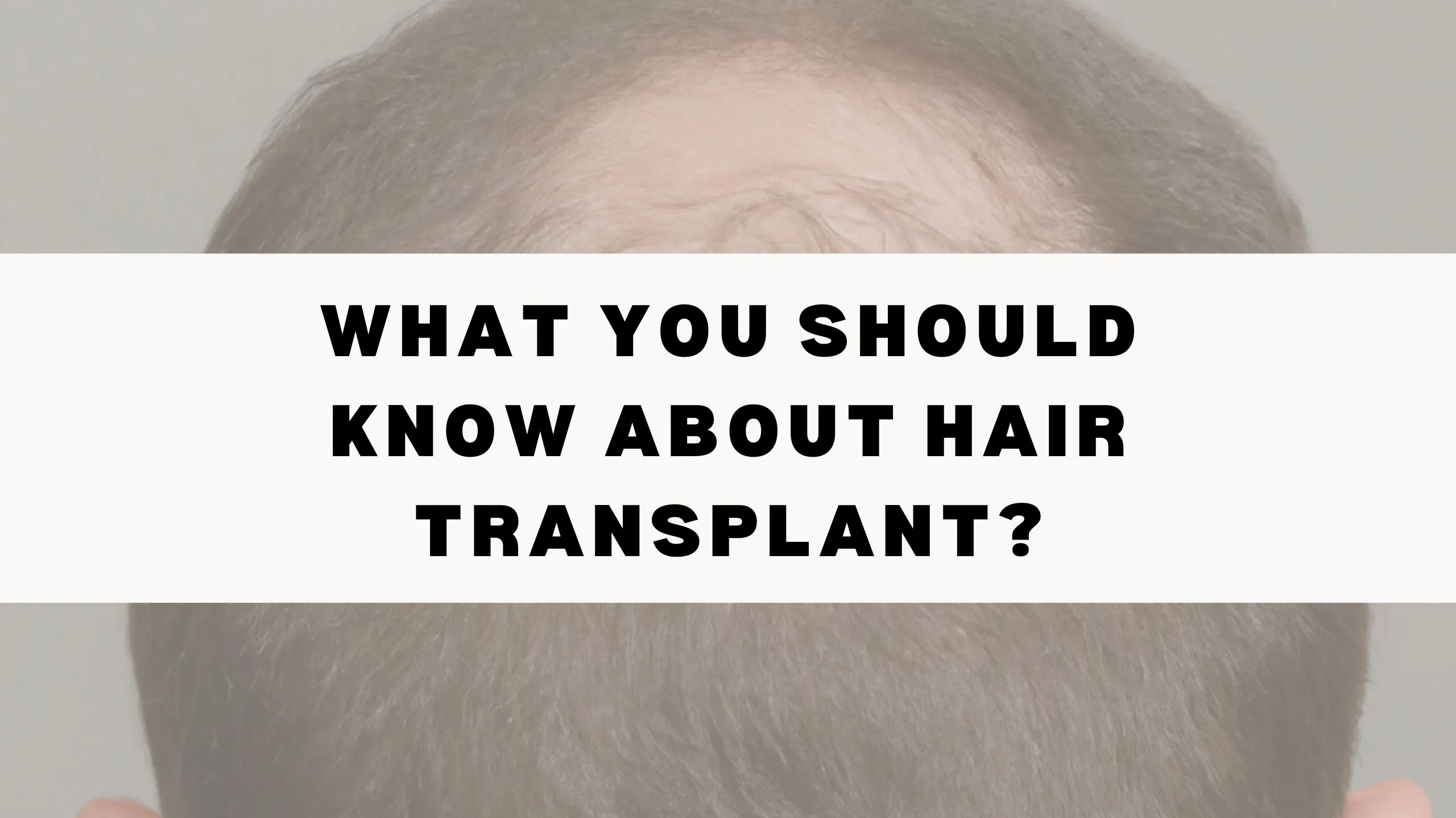 Read more about the article What You Should Know About Hair Transplant?